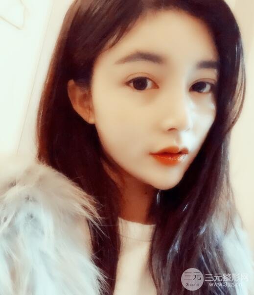 开外眼角手术后