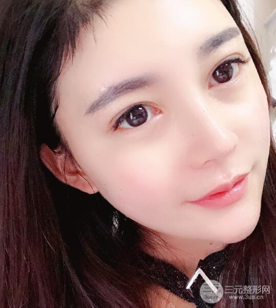 开外眼角手术后