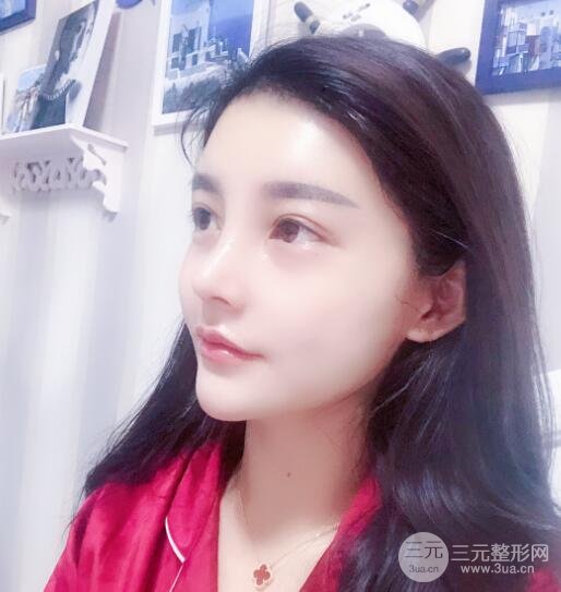 开外眼角手术后