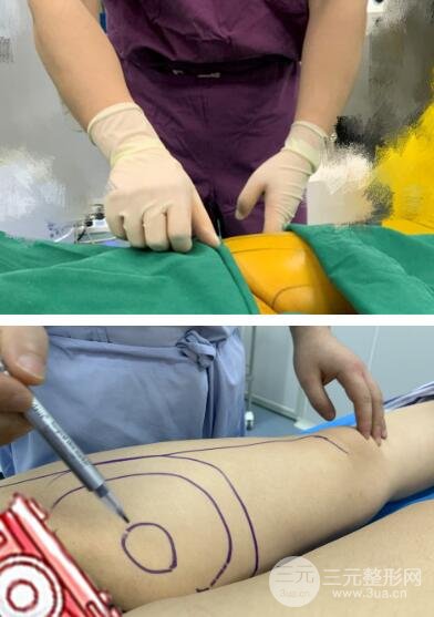 抽脂手术真实图片高清真人反馈嘟嘟肉从此永别