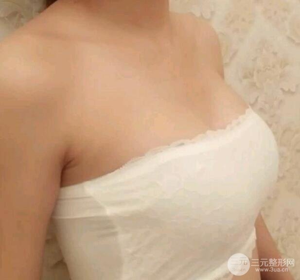 丰胸整形后: