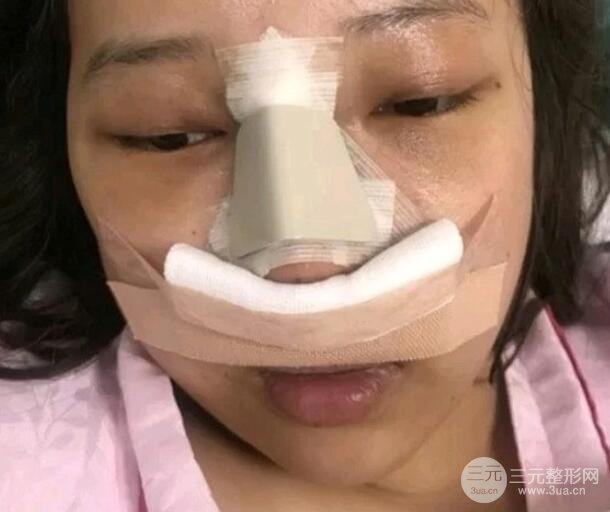 青海红十字医院整形美容科鼻子整形案例：