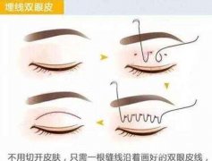 埋线不满意拆线麻烦吗？注意事项有哪些？