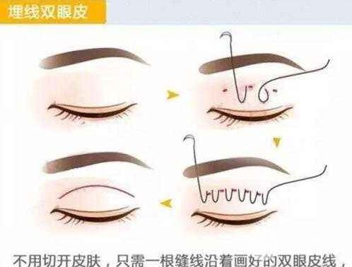 埋线不满意拆线麻烦吗