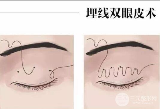埋线不满意拆线麻烦吗