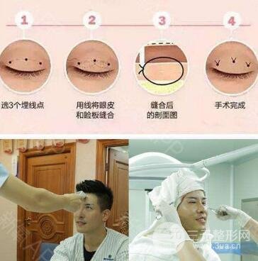 埋线不满意拆线麻烦吗