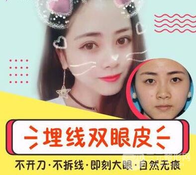 埋线不满意拆线麻烦吗