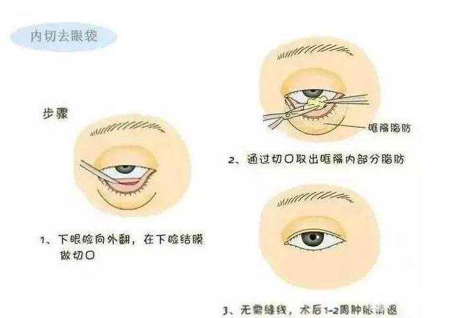 怎样才能基本去除眼袋
