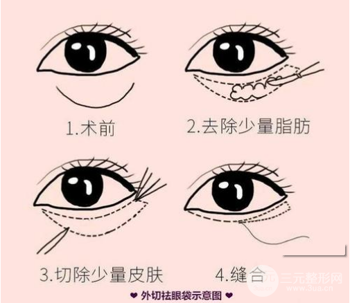 怎样基本去除眼袋