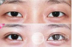 欧式眼与芭比眼的区别，超详细介绍~