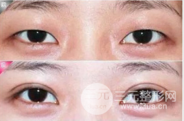 欧式眼与芭比眼的区别