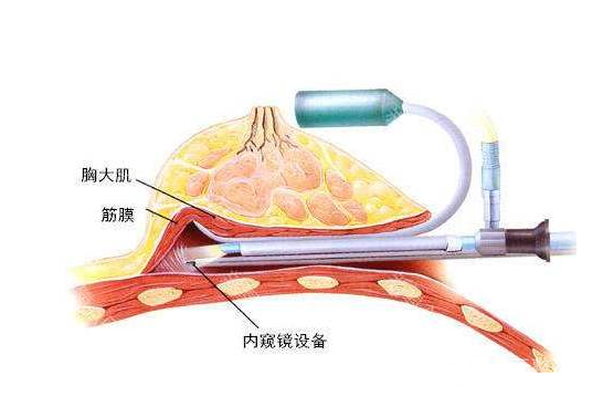 隆胸十个有九后悔