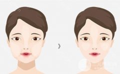 颊脂垫位置图，去颊脂垫手术适合任何人吗?