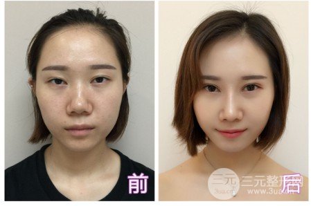 人工骨隆鼻是什么材料