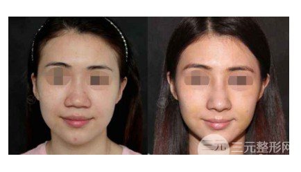 人工骨隆鼻是什么材料