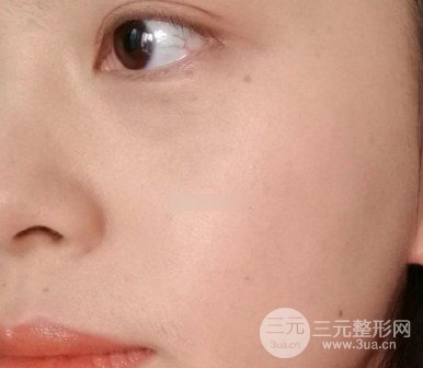 激光祛黄褐斑几次能看到果