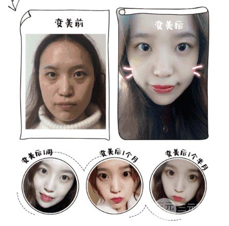 吸脂去眼袋多久能恢复