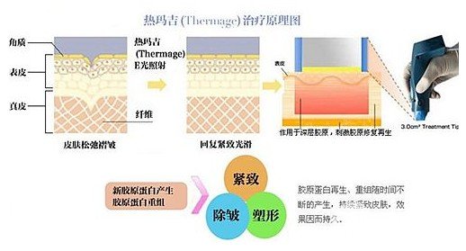 热玛吉有果吗
