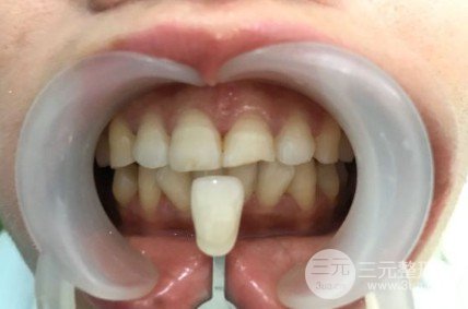 安乡张波口腔医院牙贴面