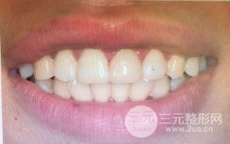 安乡张波口腔医院牙贴面