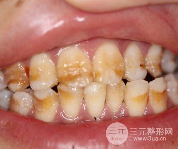 安乡张波口腔医院牙齿美白