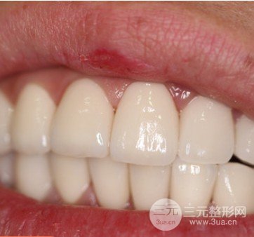 安乡张波口腔医院牙齿美白