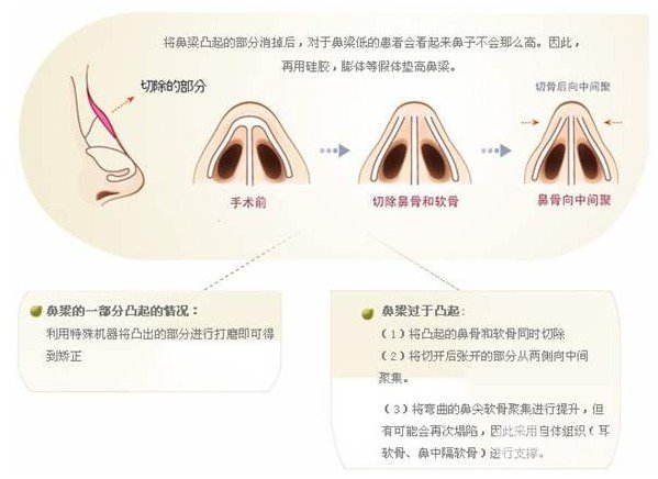 驼峰鼻整形费用贵吗