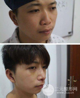 驼峰鼻整形费用贵吗