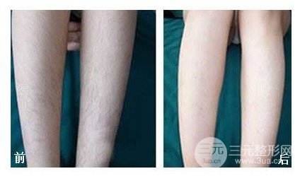 怎么样脱毛降低风险又基本