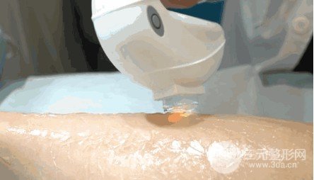 怎么样脱毛降低风险又基本