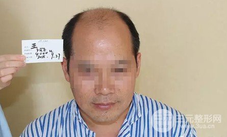 补发植发是真的有吗