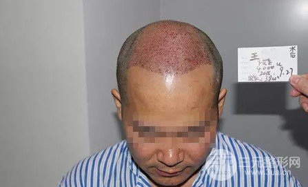 补发植发是真的有吗