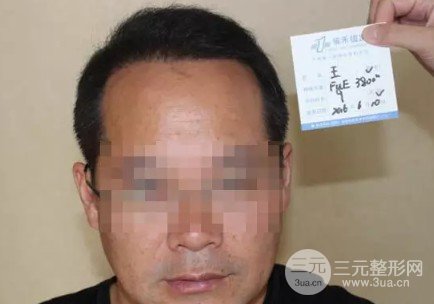 补发植发是真的有吗