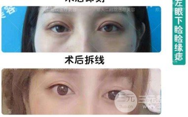上睑下垂术后12天图片