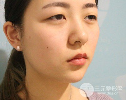 上睑下垂术后12天图片