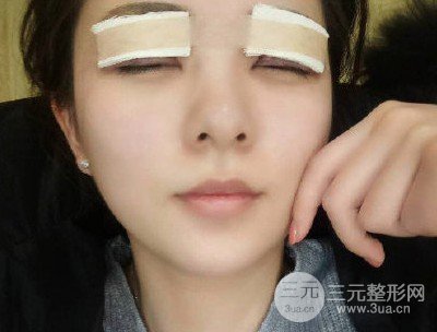 上睑下垂术后12天图片
