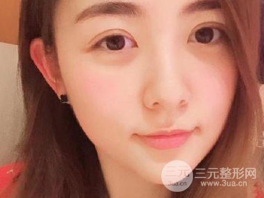 上睑下垂术后12天图片