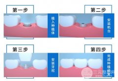 种植牙齿从开始到结束需要多少钱？成功案例图
