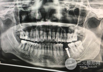 种植牙齿从开始到结束需要多少钱