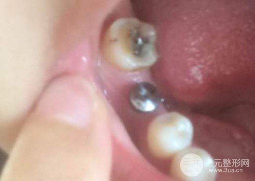 种植牙齿从开始到结束需要多少钱