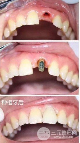 种植牙齿从开始到结束需要多少钱