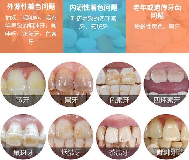 北大口腔医院讲解牙齿美白