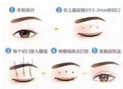 三点定位双眼皮恢复期需要多久？@你适合吗?