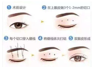 三点定位双眼皮恢复期