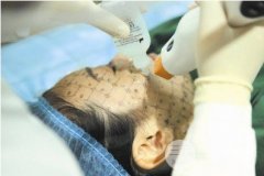 热玛吉做一次可以保持多久？一次需要多少钱?