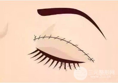疼痛感较轻双眼皮不动刀是什么原理