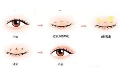 疼痛感较轻双眼皮不动刀是什么原理
