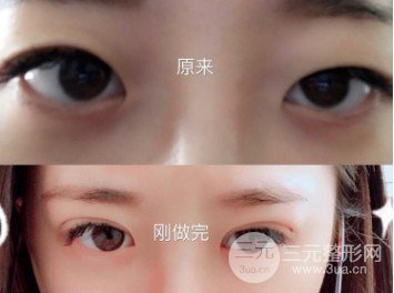 韩式微创双眼皮过程