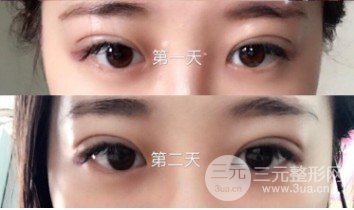 韩式微创双眼皮过程