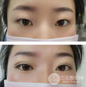 韩式微创双眼皮过程